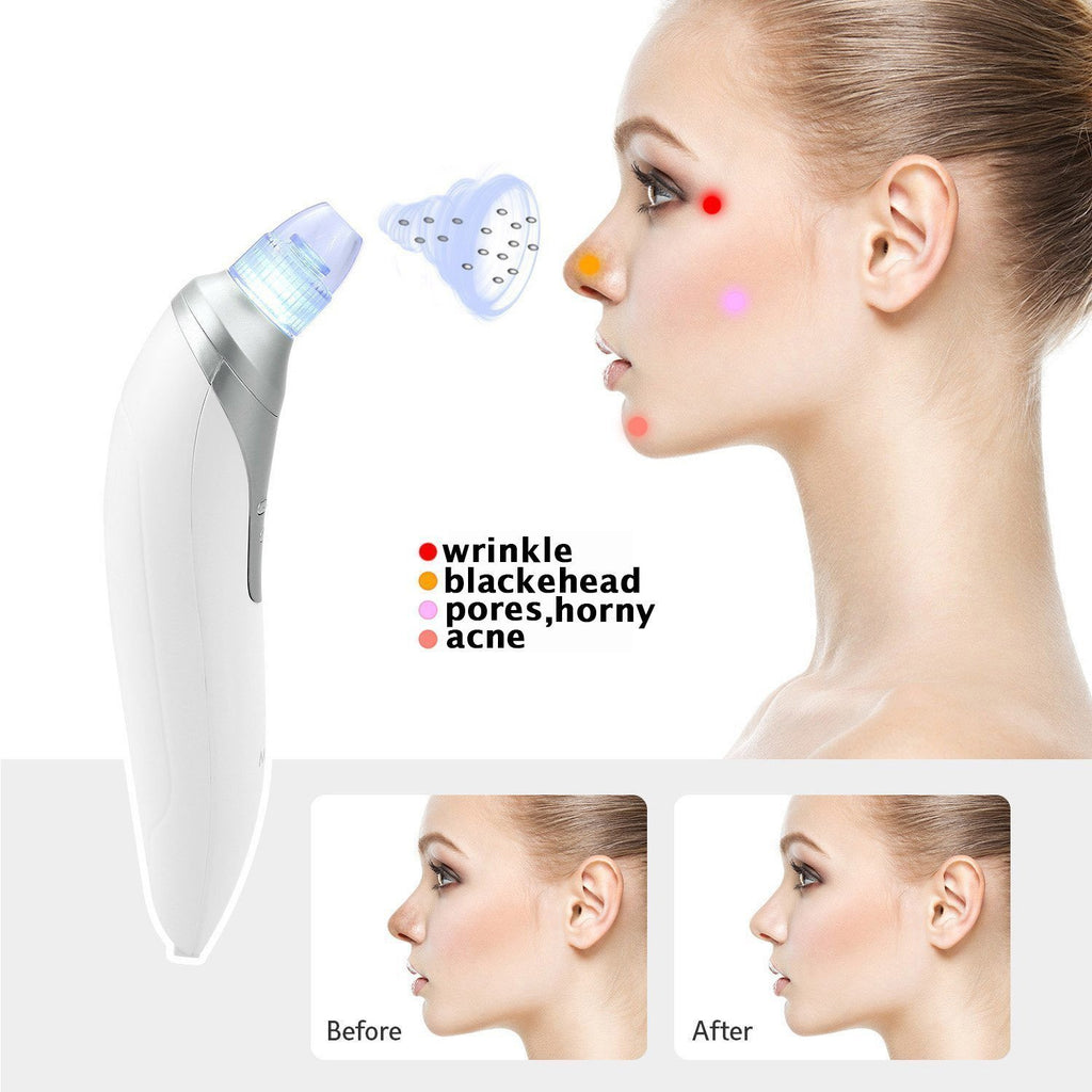 Ultimate Blackhead Remover